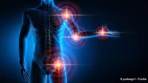 Check spelling or type a new query. Spondylarthrose Ausloser Symptome Und Behandlung Netdoktor