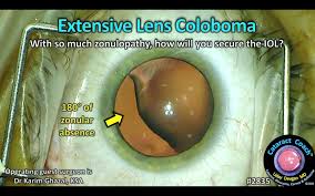 Image result for Coloboma