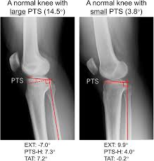 Image result for Knee XRay