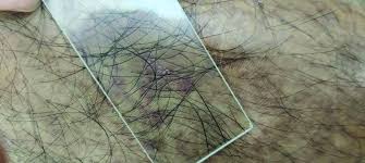 Image result for Diascopy