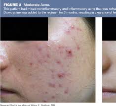 Treatment selection is based on disease severity, patient preference, and. Pdf Pharmacologic Treatment Options In Mild Moderate And Severe Acne Vulgaris Semantic Scholar