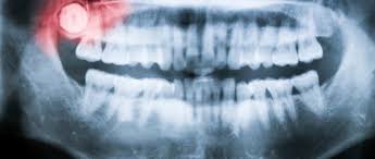 How much does wisdom tooth removal cost? Is Wisdom Teeth Removal Really Warranted Healthy Debate