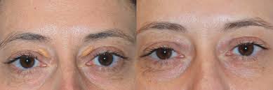 Image result for xanthelasma of eyelid