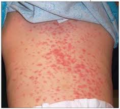 This virus is spread through saliva, and you may catch it from kissing or from sharing food or drinks. Infant With Persistent Fever And Cough Worsening Rash