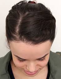 New hairstyles for thinning hair in front female 50 best hairstyles for thin hair smart ideas, source:herinterest.com. Hair Restoration For Women Manhattan Nyc True Dorin Medical Group Hair Loss