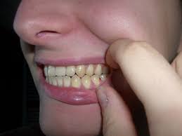 I Can T Close My Mouth More Than This Tooth Erosion Is Pretty Sucky Dentistry
