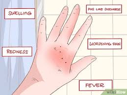 Maybe you would like to learn more about one of these? How To Treat A Dog Bite Expert First Aid To Prevent Infection