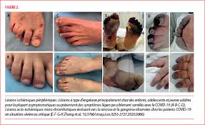 This page was cut for reason: Manifestations Cutanees Associees Au Covid 19 Louvain Medical