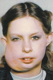 Shelley Hull On What Her Battle With Facial Disfigurement Taught Her About  Beauty