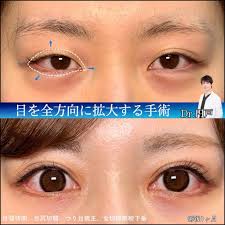 目尻 切開 やりすぎ