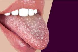 Mundfaule Ursachen Symptome Diagnose Behandlung Hausmittel Krank De