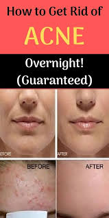 In the event that fresh peppermint leaves are not found it kills off the bacteria that may be creating all the pimple problem in the first place. How To Get Rid Of Acne Overnight 100 Guaranteed How To Get Rid Of Acne Acne Overnight How To Remove Pimples