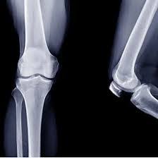 Image result for Knee XRay