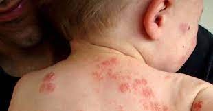 Treat Eczema Naturally With Fish Oil And Oatmeal Natural Cure For Eczema Psoriasis In Children How To Treat Eczema