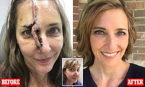 30.05.2018 · don't mistake these skin conditions for the common zit: Tanning Addict Who Enjoys Being Burnt Discovered A Pimple On Her Nose Turned Out To Be Skin Cancer Daily Mail Online