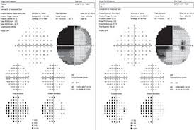 Image result for Visual Field Deficit