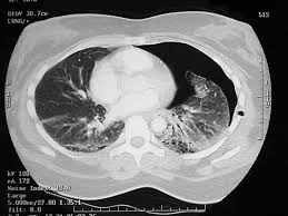 Image result for Pneumothorax