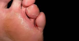 Image result for flegmona pedis)