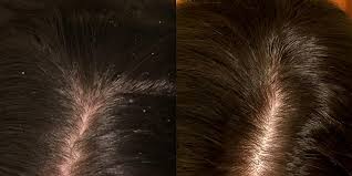 The shampoo acts as a scalp treatment—it kills the yeast, inflammation decreases. Here S What Dermatologists Have To Say About Nizoral A D Anti Dandruff Shampoo