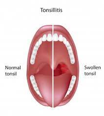Recurring throat pain and tonsillitis may be signs you should get your tonsils removed. All About Tonsils Harris Dental
