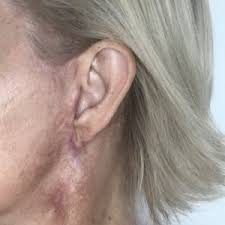 We have years of experience in body modification , being among the first to bring this art to the uk. Bad Scar Around Ear Too Tight Skin Pixie Ear Loose Skin Under Chin Stretchmarks Advice For Improvement Photo
