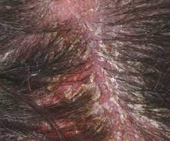 Scabs On Scalp Causes Get Rid Treat Small Random Itchy Dry Yellow White Scalp Scabs Bleedin Severe Dandruff Dandruff Treatment Dandruff Treatment Shampoos