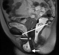 We have 10 images about mri pelvis muscle anatomy including images, pictures, photos, wallpapers, and more. Pelvic Floor Failure Mr Imaging Evaluation Of Anatomic And Functional Abnormalities Radiographics