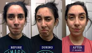Prid Vs Nexcare Acne Patches Battle Of The Holistic Spot Treatments Crappy Candle