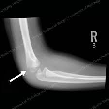 As you recover, physical therapy prevents the arm and shoulder muscles from becoming weak and helps. Elbow Fractures In Children An Overview Hss Edu