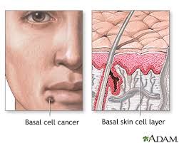 But hearing the words can still be scary. Basal Cell Skin Cancer Medlineplus Medical Encyclopedia