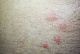 Spencer Pest Serviceswhat Do Flea Bites Look Like Spencer Pest Services