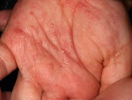 Image result for scabies human bites