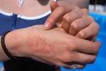 Winter Rash On Hands