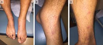 If there is application of excessive force or pressure to the body tissue, then this stress causes the development of the petechiae spots. Case Challenge A 20 Year Old Man With Pain And Swelling Of The Left Calf And A Purpuric Rash Nejm
