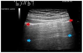 Goldenview ultrasound also offers early gender determination ultrasounds in 2d, 3d, 4d and hdlive starting at just 14 weeks. Ijerph Free Full Text Does Lung Ultrasound Have A Role In The Clinical Management Of Pregnant Women With Sars Cov2 Infection Html