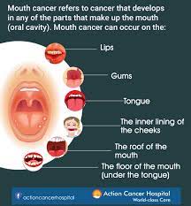 Alcohol and tobacco use are the biggest risk factors for gum cancers and other types of oral cancer. Action Cancer Hospital In The Early Stages Mouth Cancer Rarely Causes Any Pain Abnormal Cell Growth Usually Appears As Flat Patches A Canker Sore Looks Like An Ulcer Usually With A