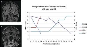 Memory loss that interferes with daily life. The Natural History Of Early Onset Dementia The Artemis Project Bmj Open