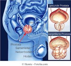 Chronische Prostatitis Antibiotika Prostataentzundung Mann Antibiotika