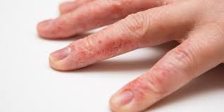 For severe eczema or as an occasional treatment for intense itch, add another step after your bath. Hand Eczema 8 Ways To Deal With This Frustrating Condition Self