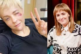 Bjelle pasivažinėjimas paspirtuku baigėsi sunkiais sužalojimais: „Laukia 2  mėn. įtvare, mėnuo tik skysto maisto ir traumos visam gyvenimui“