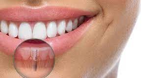 Protese Fixa Ou Implante Dentario Qual E A Melhor Opcao Dentista Tijuca Copacabana Clinica Odontologica Rj