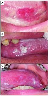 Image result for white cancer on tongue)