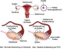 Pcos, polycystic ovary syndrome is a disorder or more likely a hormonal disorder which is common women who conceive with pcos have higher chances of premature delivery, gestational diabetes. Pcos Ursachen Symptome Behandlung Netdoktor At