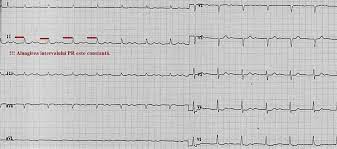 Simptomele pentru blocul de ramură. Interpretarea TulburÄrilor De Conducere Ale Inimii Pe Ekg NoÈiuni De Fiziopatologie Pentru StudenÈi Newsmed Ro