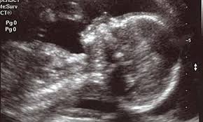 The medical test is more accurate than tests you can purchase from a drug store. Pregnancy Scans Nz Cost