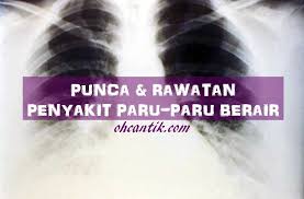 Dapatkan berita terkini mengenai paru+paru+berair dan cari tajuk utama berita terkini mengenai paru+paru+berair dari astro awani. Punca Paru Paru Berair Tanda Sokongan Rawatan Ohcantik Com