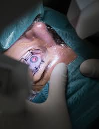 The rare infection affects the nose, eyes and in some cases the brain. A Black Fungus Infection Is Killing Covid 19 Patients In India Aim