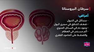 غدة البروستاتا هذه تشبه، في شكلها سرطان البروستاتا هو واحد من أكثر السرطانات الشائعة التي تظهر عند الذكور. Ø³Ø±Ø·Ø§Ù† Ø§Ù„Ø¨Ø±ÙˆØ³ØªØ§ØªØ§ Ø§Ù„Ø£Ø¹Ø±Ø§Ø¶ ÙˆØ§Ù„Ø¹Ù„Ø§Ø¬ Youtube