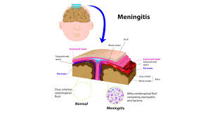 Causes of encephalitis and meningitis include viruses. Meningitis Headway