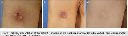 Image result for syphilis ulcer